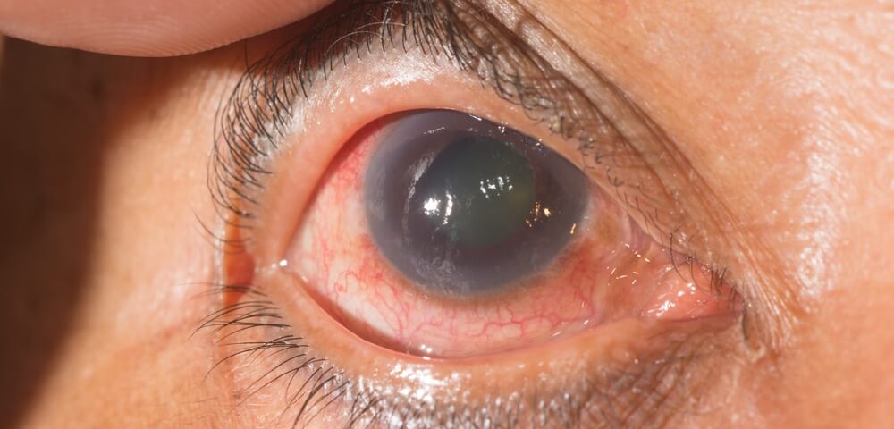 cirurgia-de-glaucoma-clinica-popular-teresina-saude-dirceu